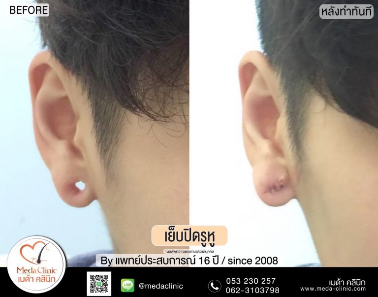 เย็บรูหู