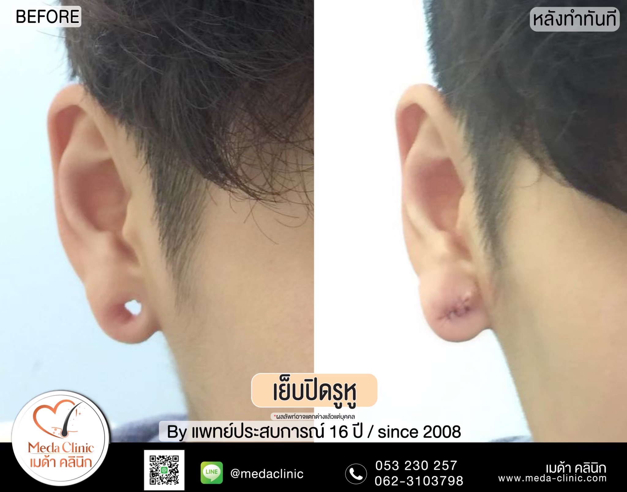 เย็บรูหู