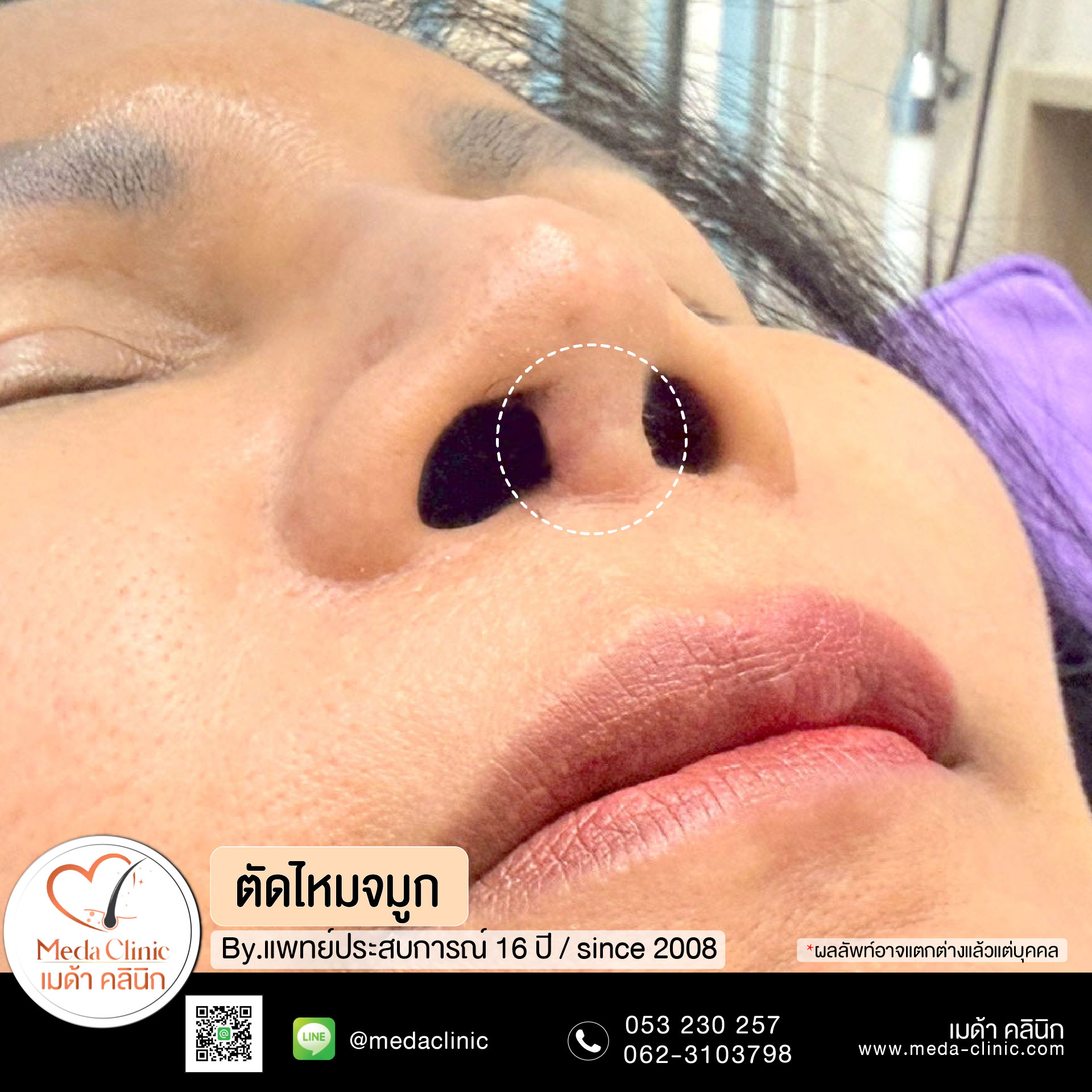 ตัดไหมเชียงใหม่