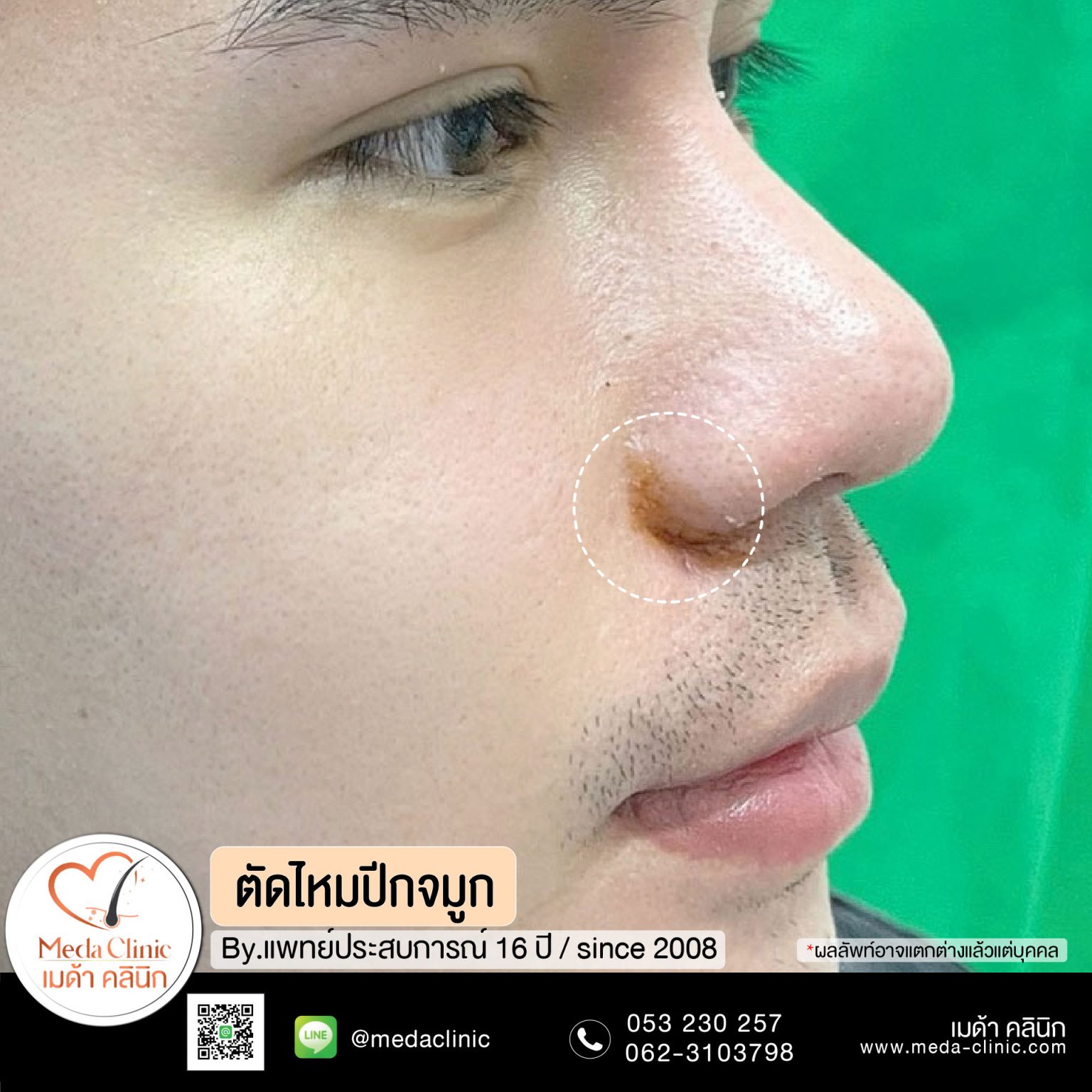 ตัดไหมเชียงใหม่