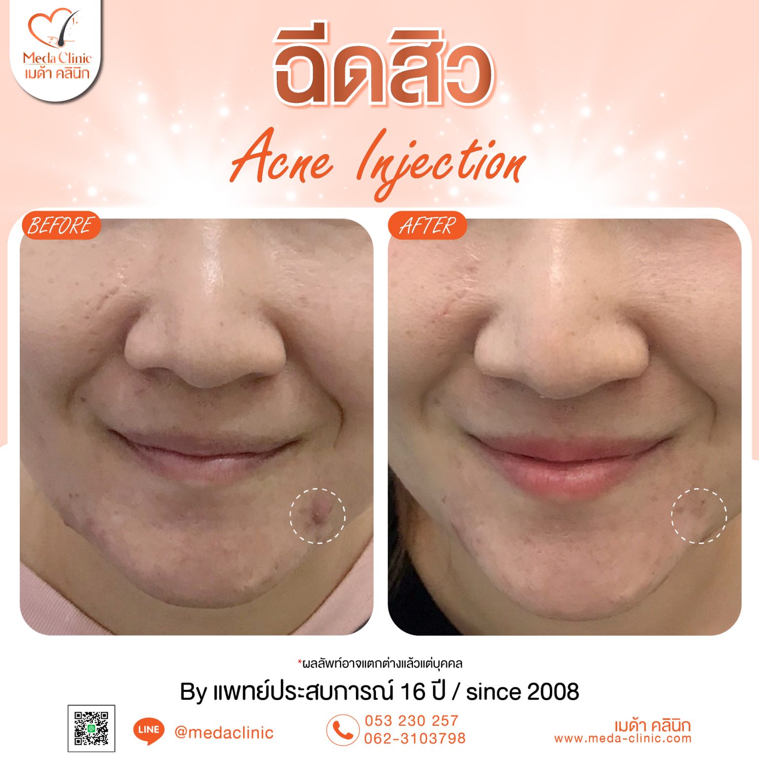 ฉีดสิวเชียงใหม่