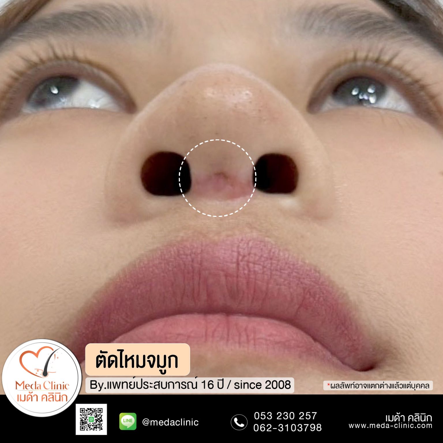 ตัดไหมเชียงใหม่