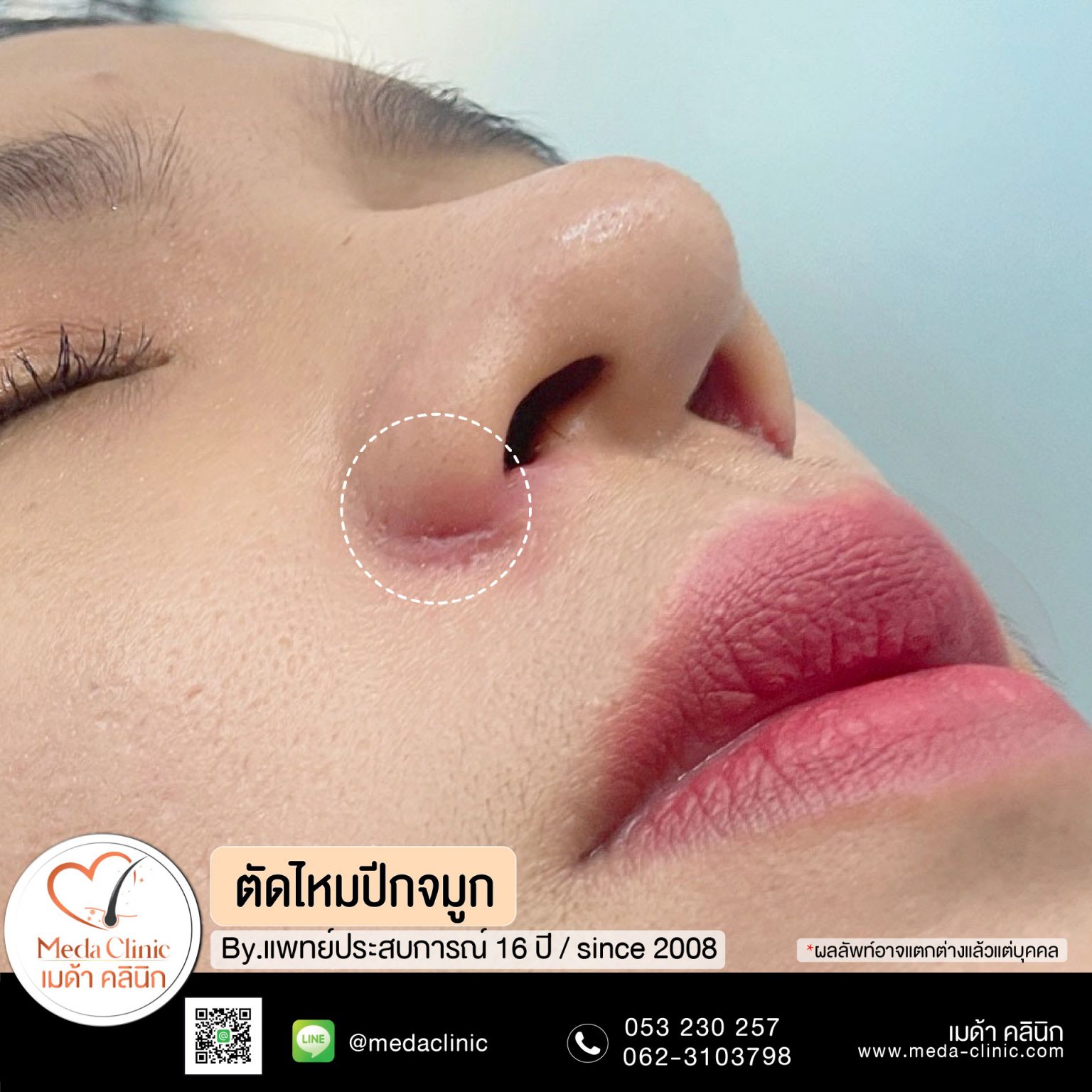 ตัดไหมเชียงใหม่