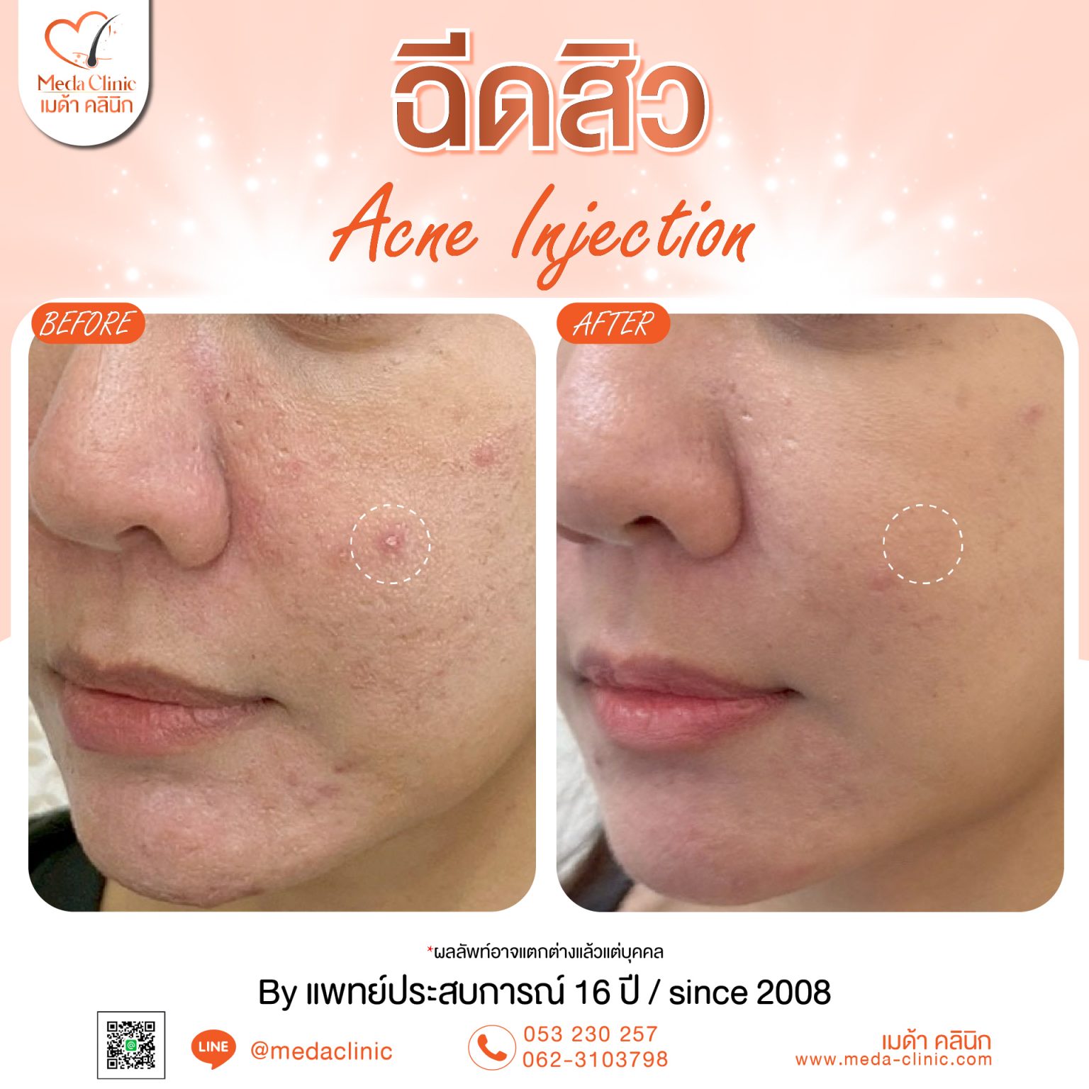 ฉีดสิวเชียงใหม่