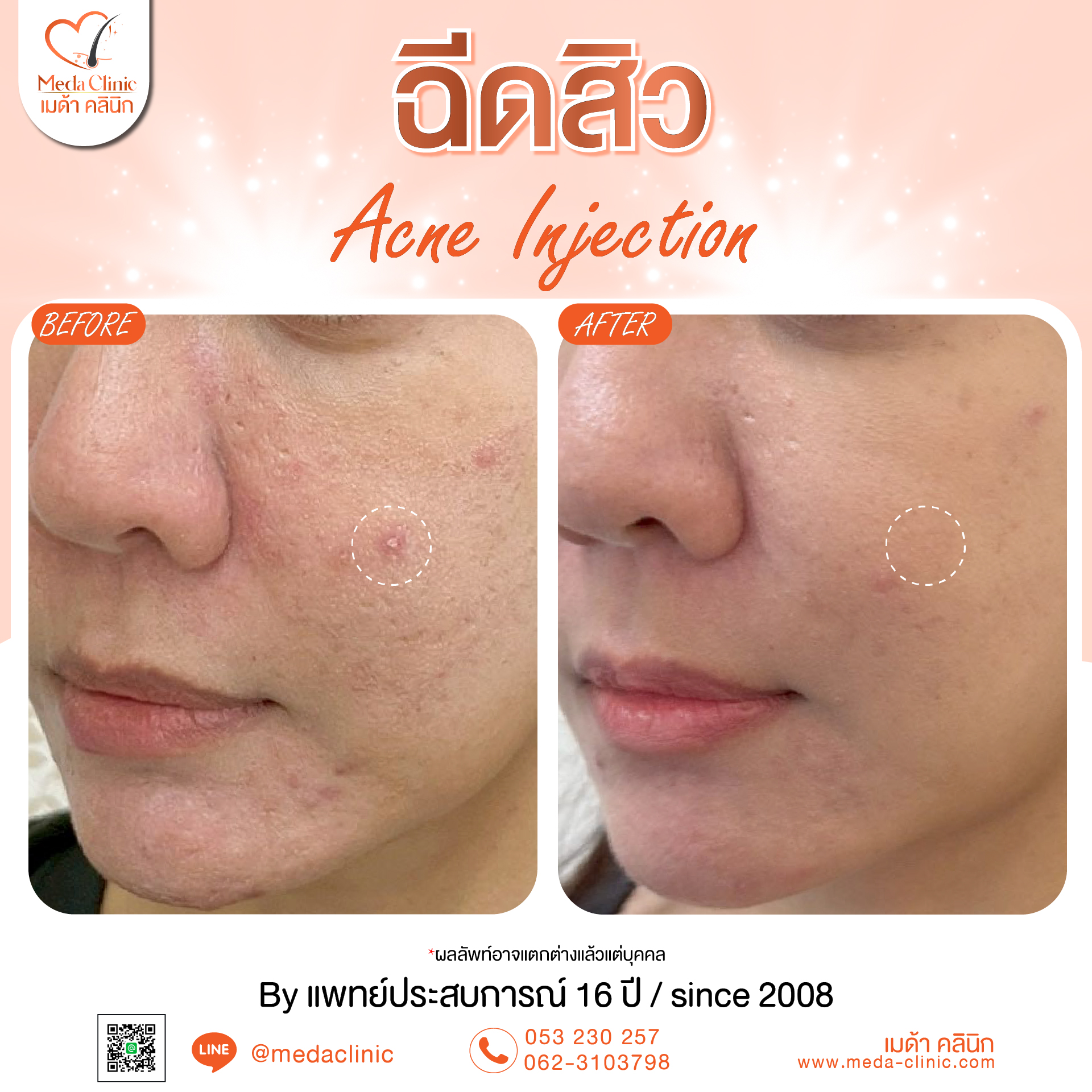 ฉีดสิวเชียงใหม่