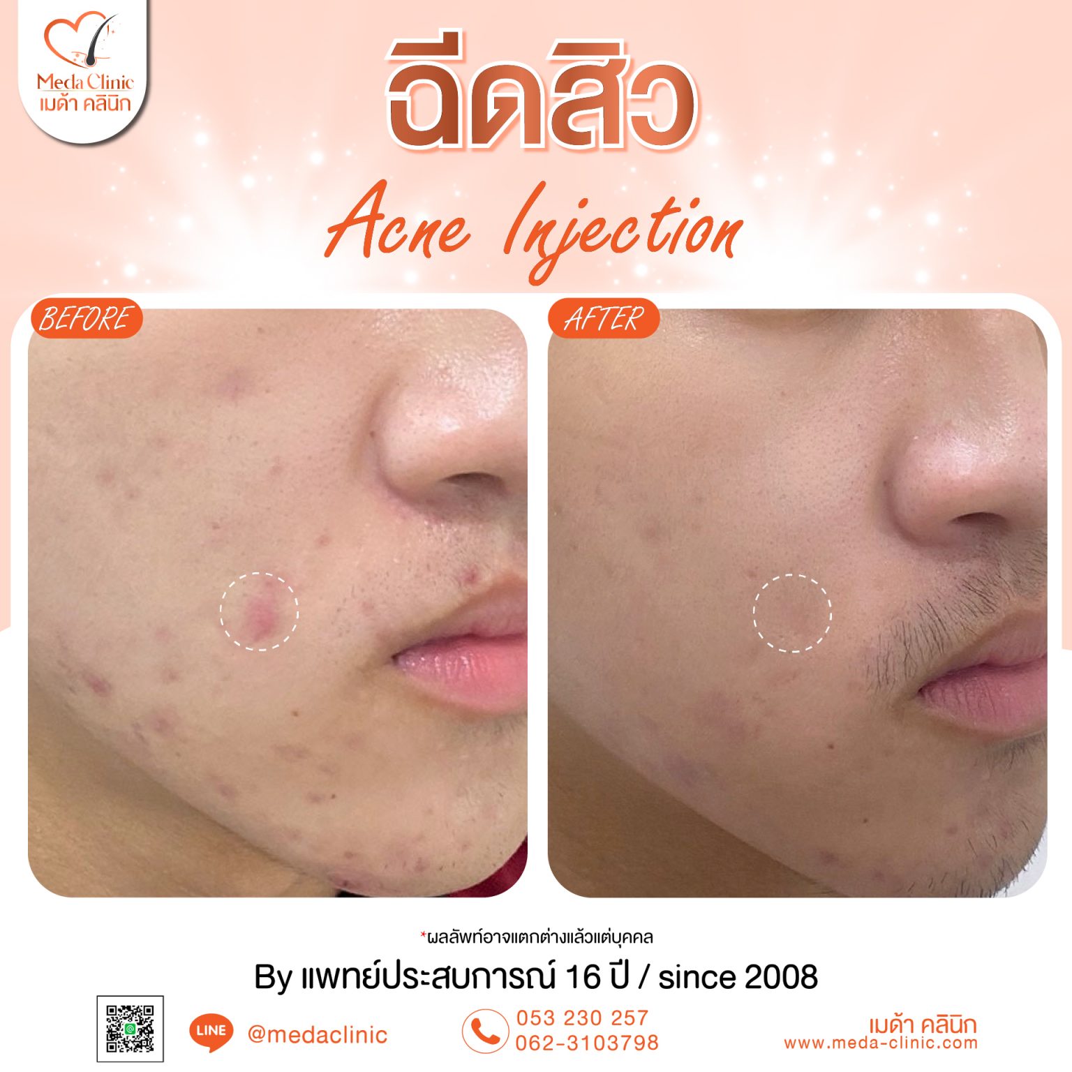 ฉีดสิวเชียงใหม่