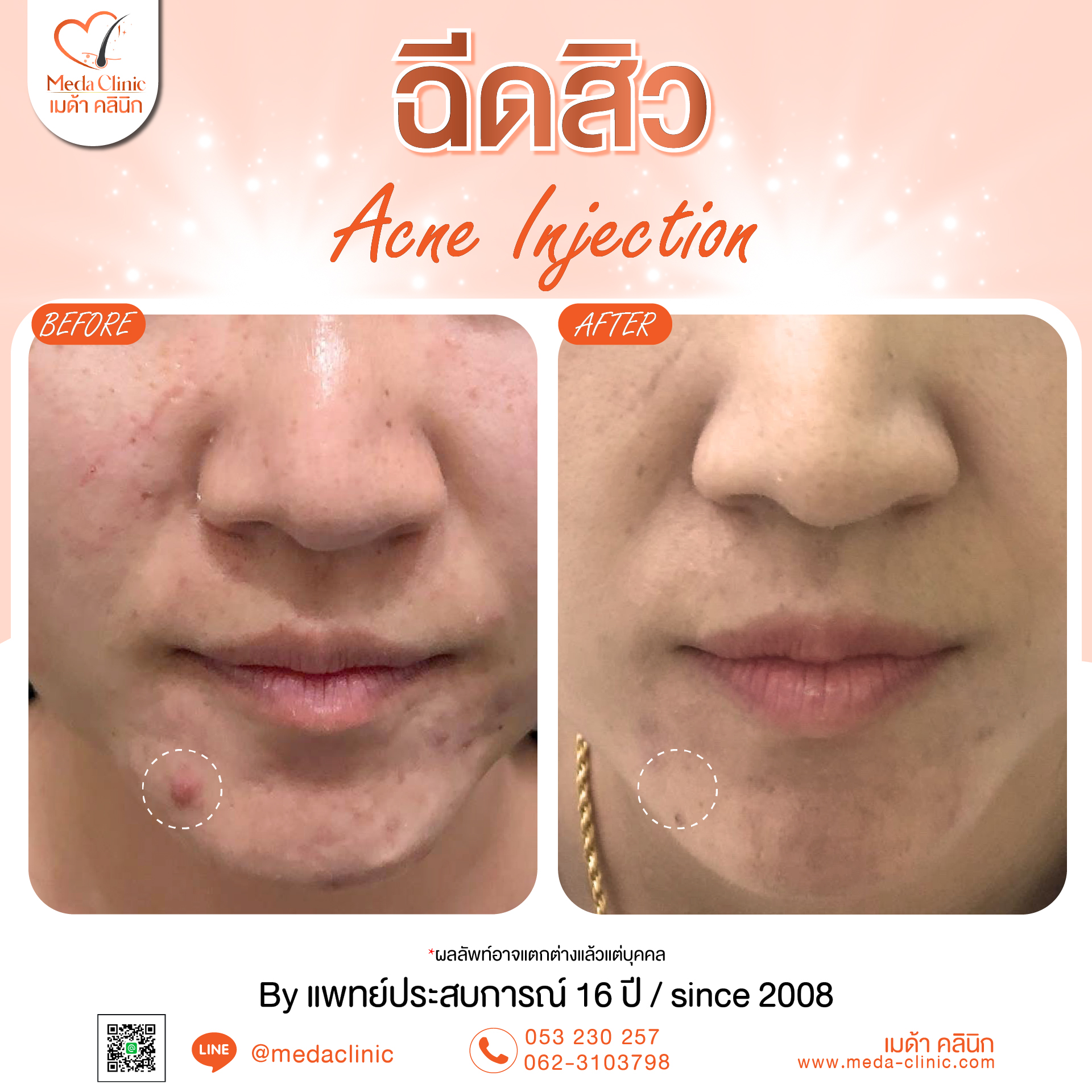 https://www.lannawadeeclinic.com/%e0%b8%89%e0%b8%b5%e0%b8%94%e0%b8%aa%e0%b8%b4%e0%b8%a7%e0%b9%80%e0%b8%8a%e0%b8%b5%e0%b8%a2%e0%b8%87%e0%b9%83%e0%b8%ab%e0%b8%a1%e0%b9%88/