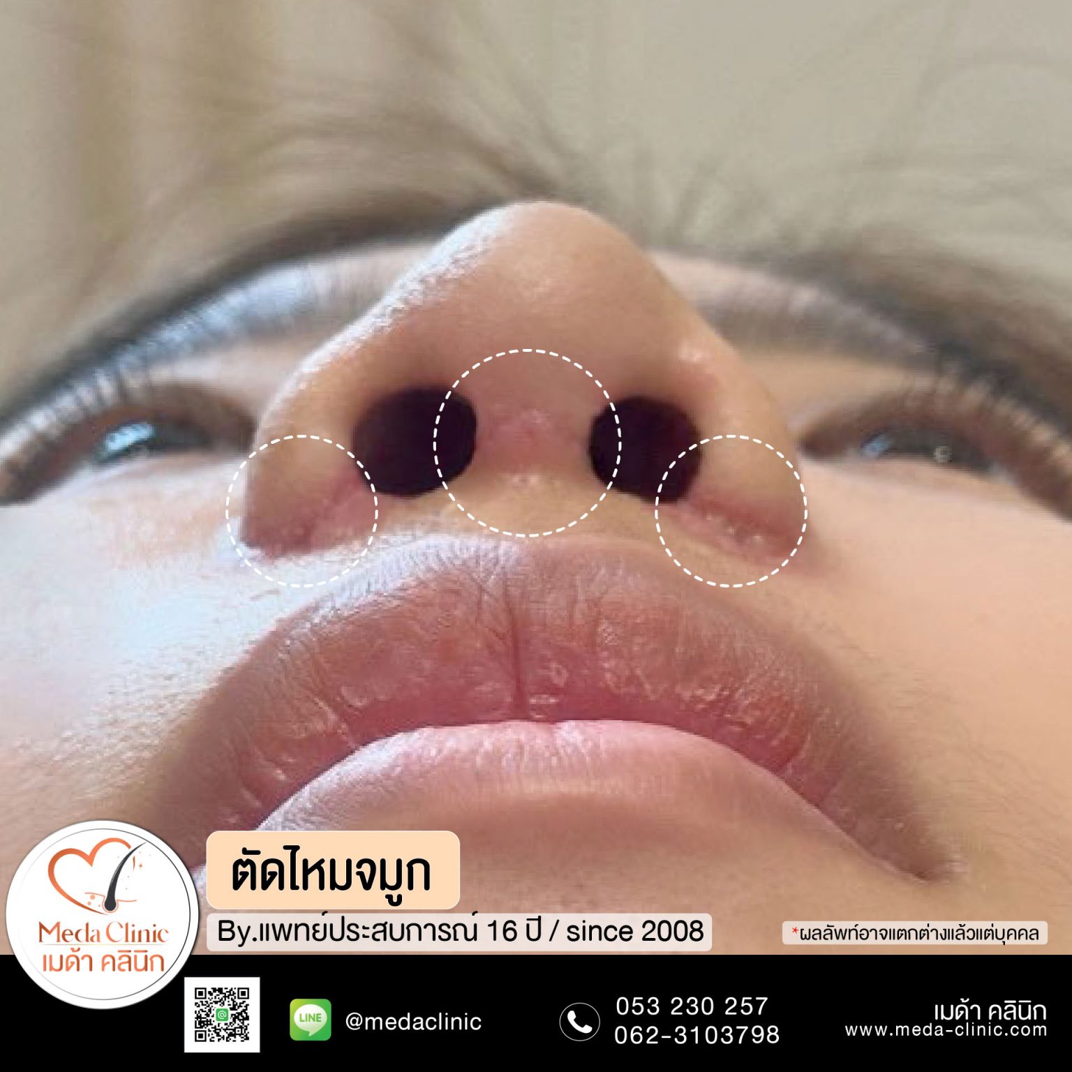 ตัดไหมเชียงใหม่