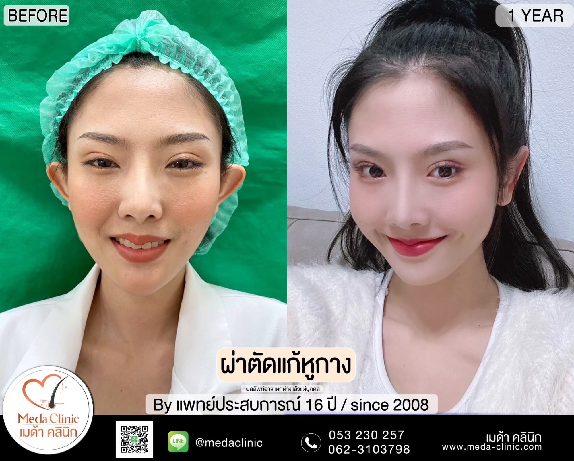 แก้หูกาง