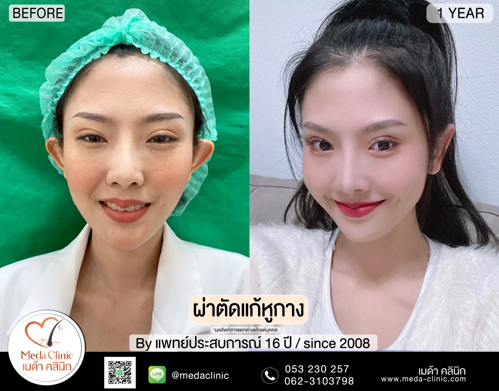 แก้หูกาง