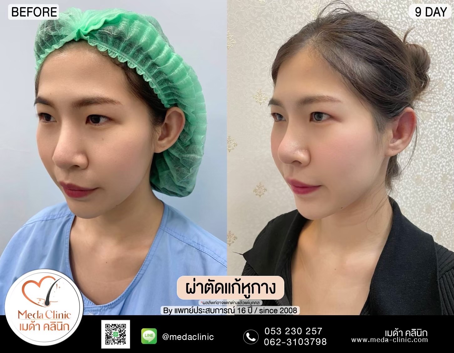 แก้หูกาง