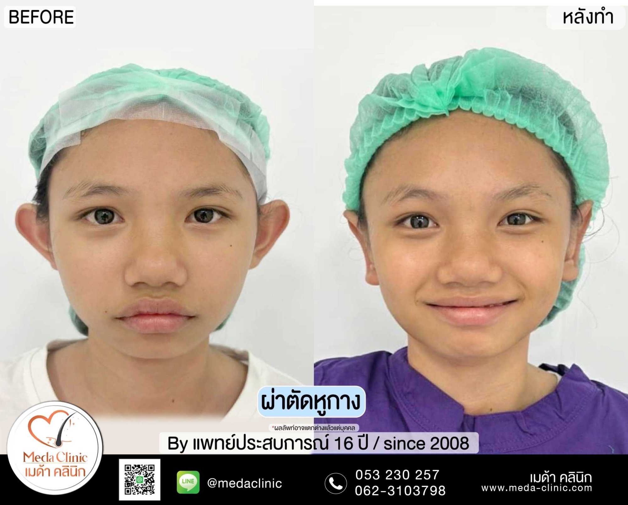 แก้หูกาง