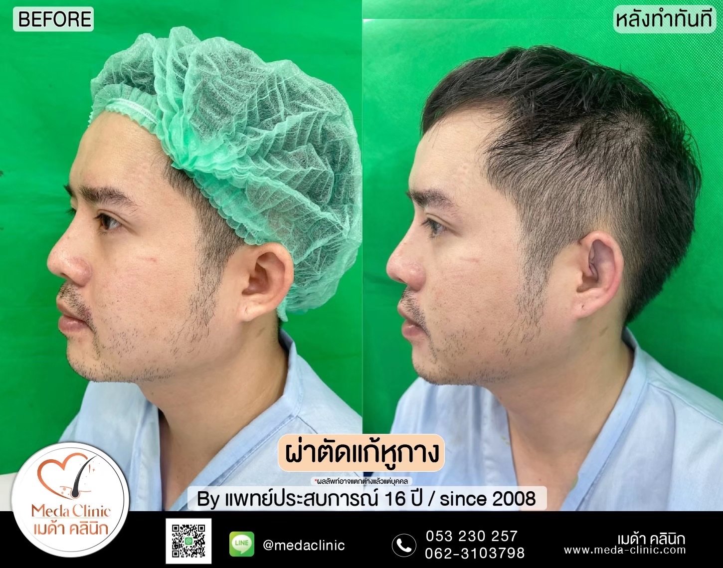 แก้หูกาง