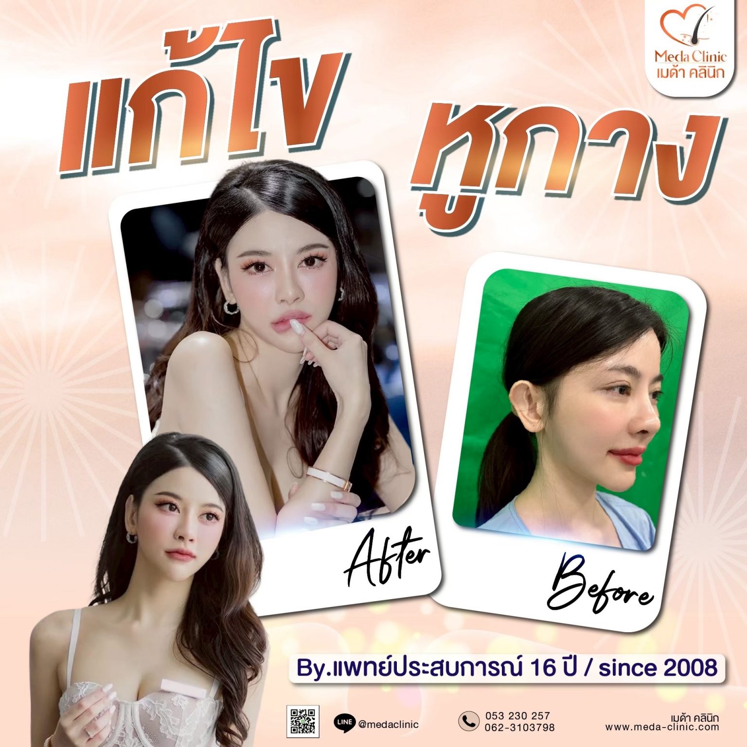 แก้หูกาง