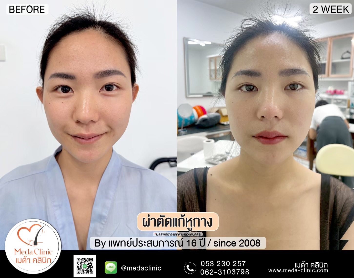 แก้หูกาง