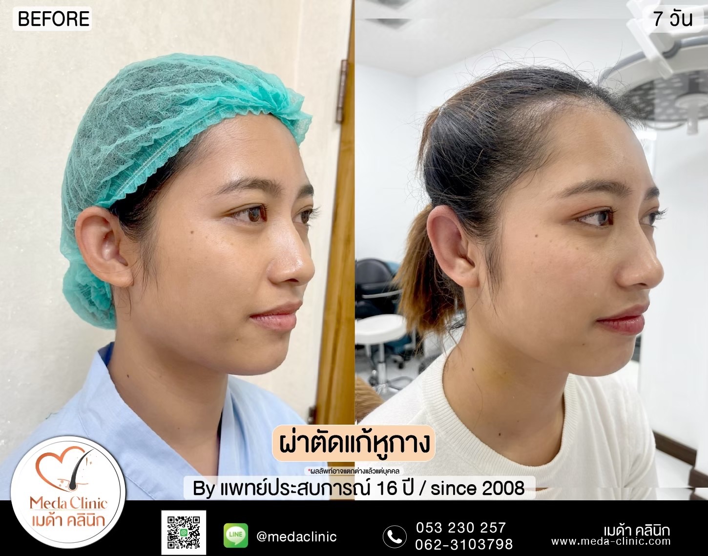 แก้หูกาง