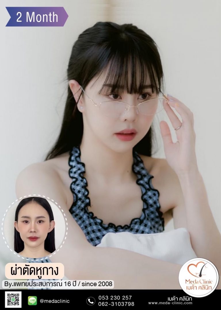 ผ่าตัดแก้หูกาง