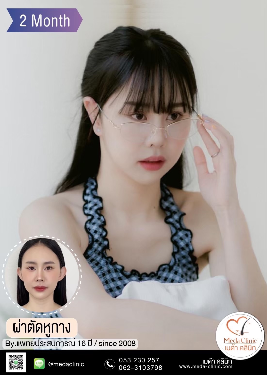 ผ่าตัดแก้หูกาง