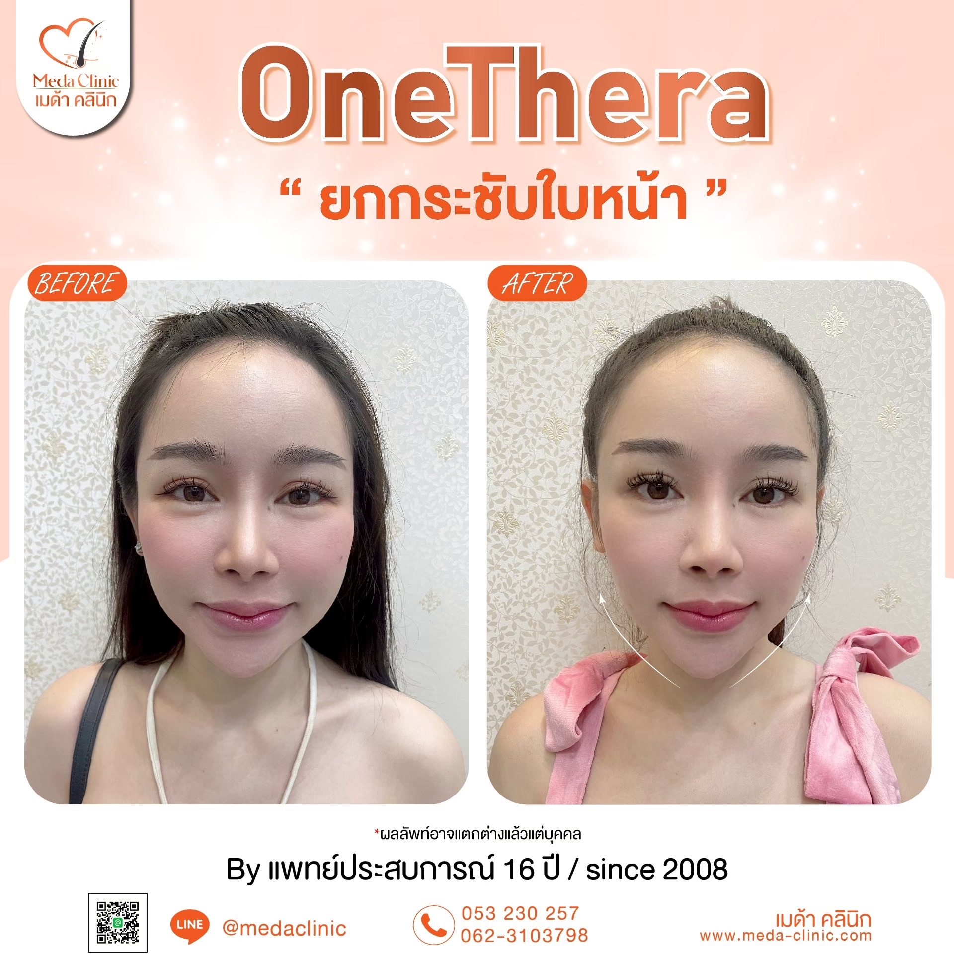 การยกกระชับใบหน้า