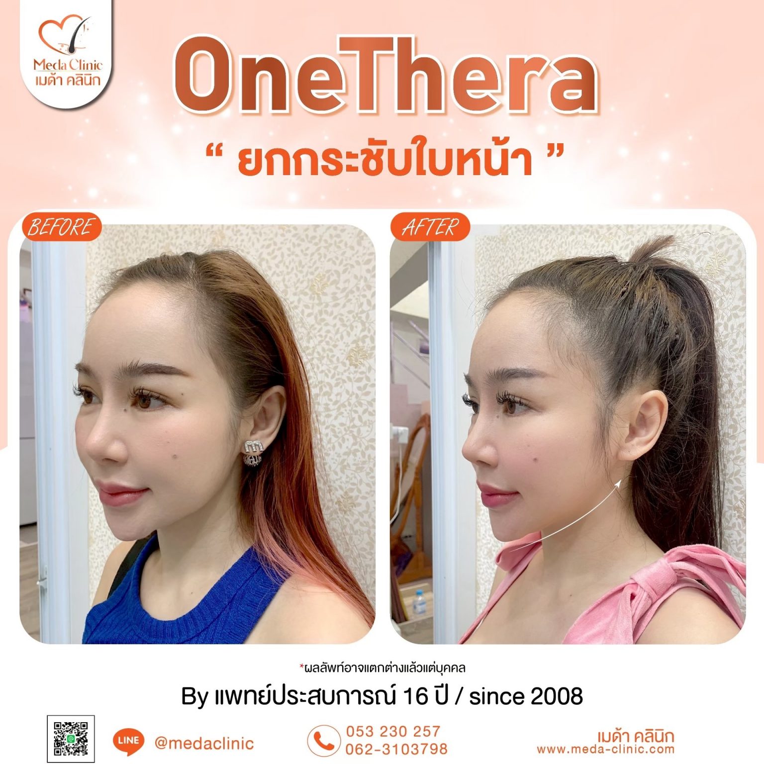 ยกกระชับใบหน้า
