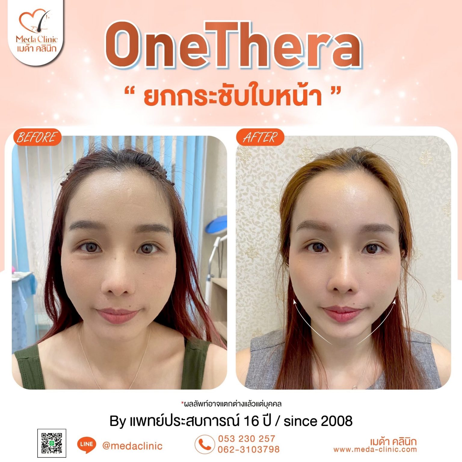 ยกกระชับใบหน้า