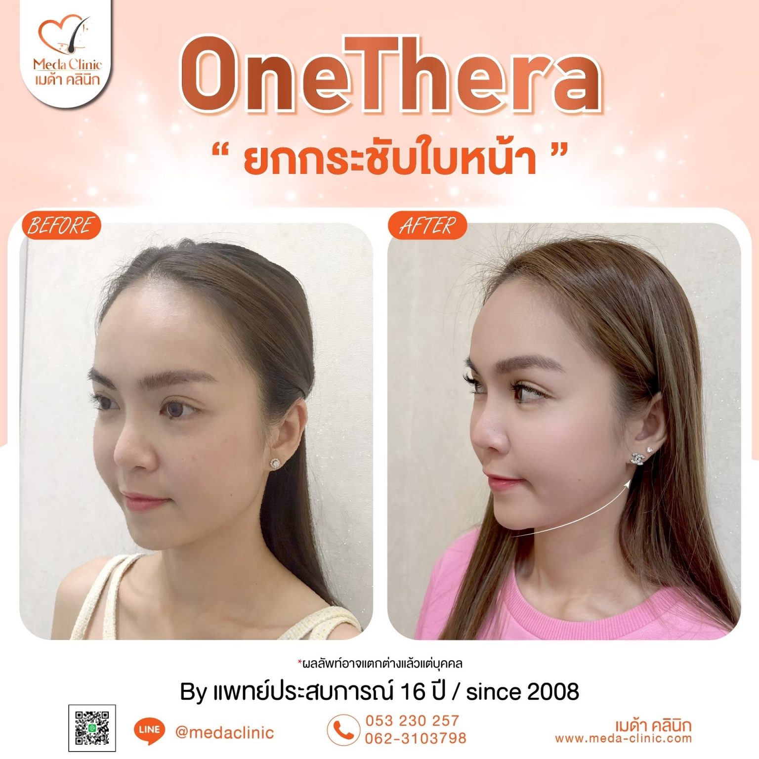ยกกระชับใบหน้า