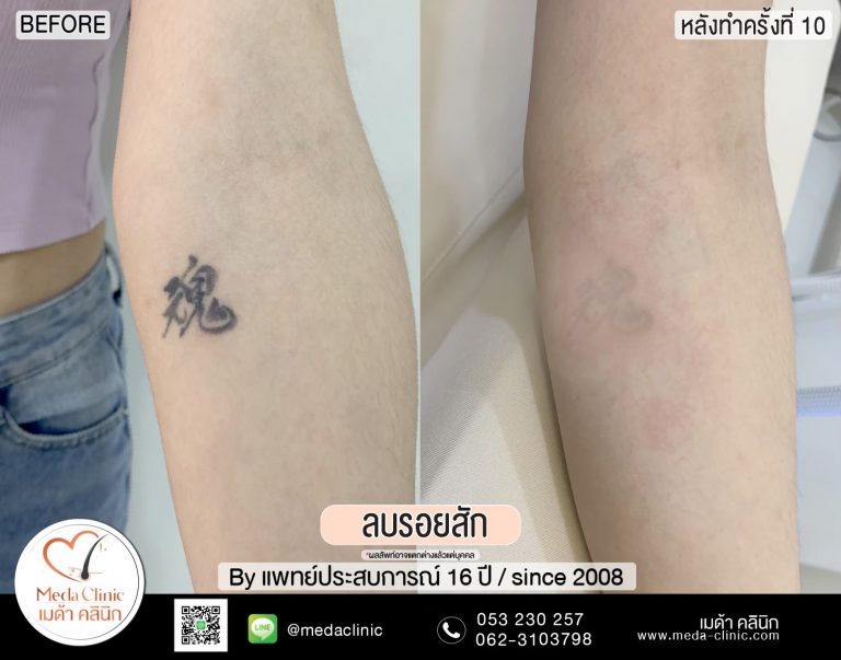 ลบรอยสัก