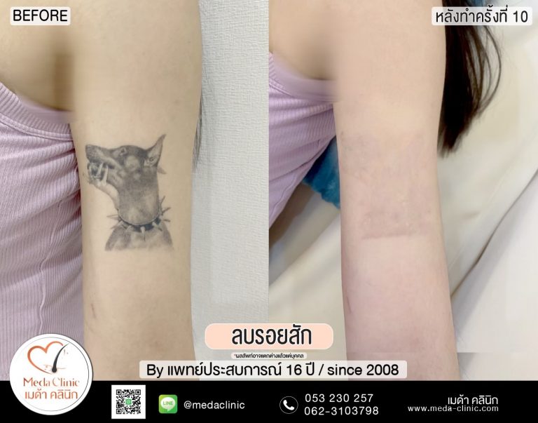 ลบรอยสัก