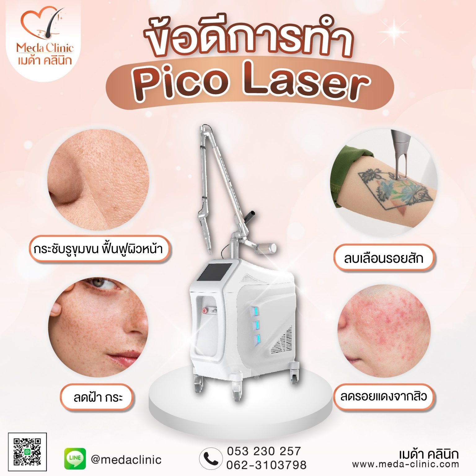 ลบรอยสัก