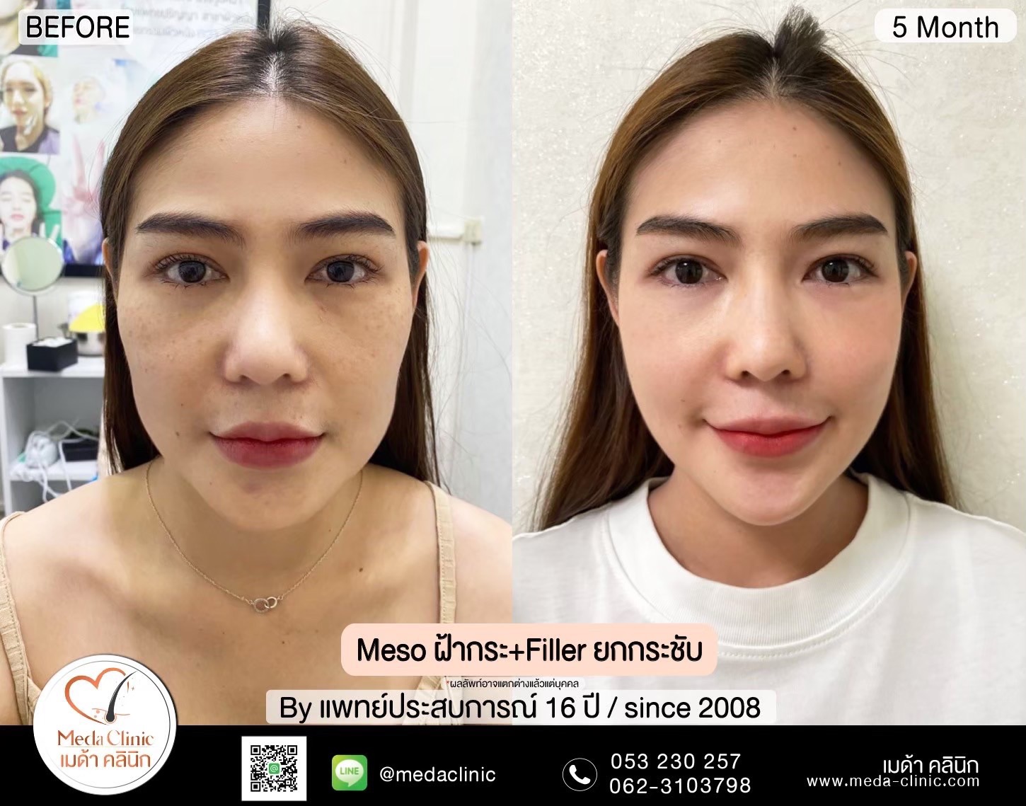 คลินิกรักษาฝ้ากระ