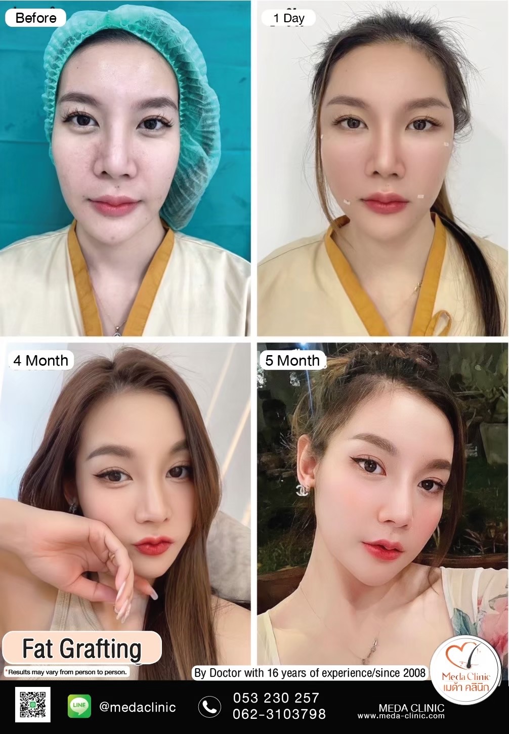 Fat Transfer Chiangmai