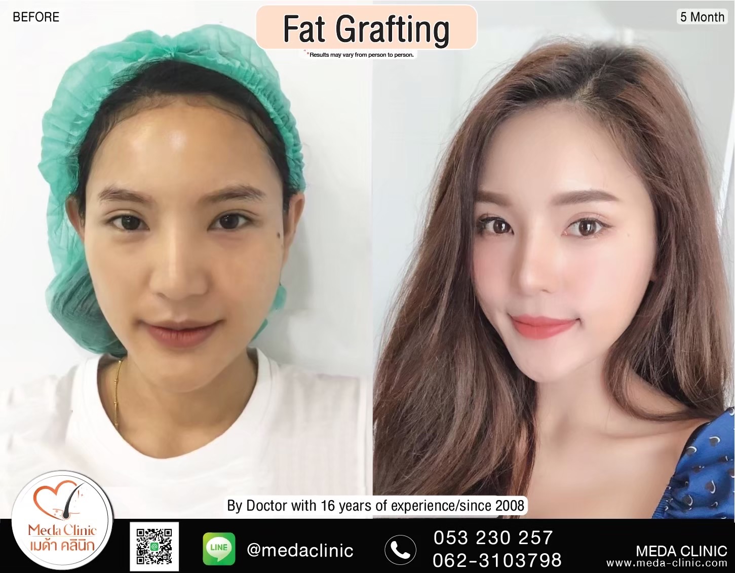 Fat Transfer Chiangmai