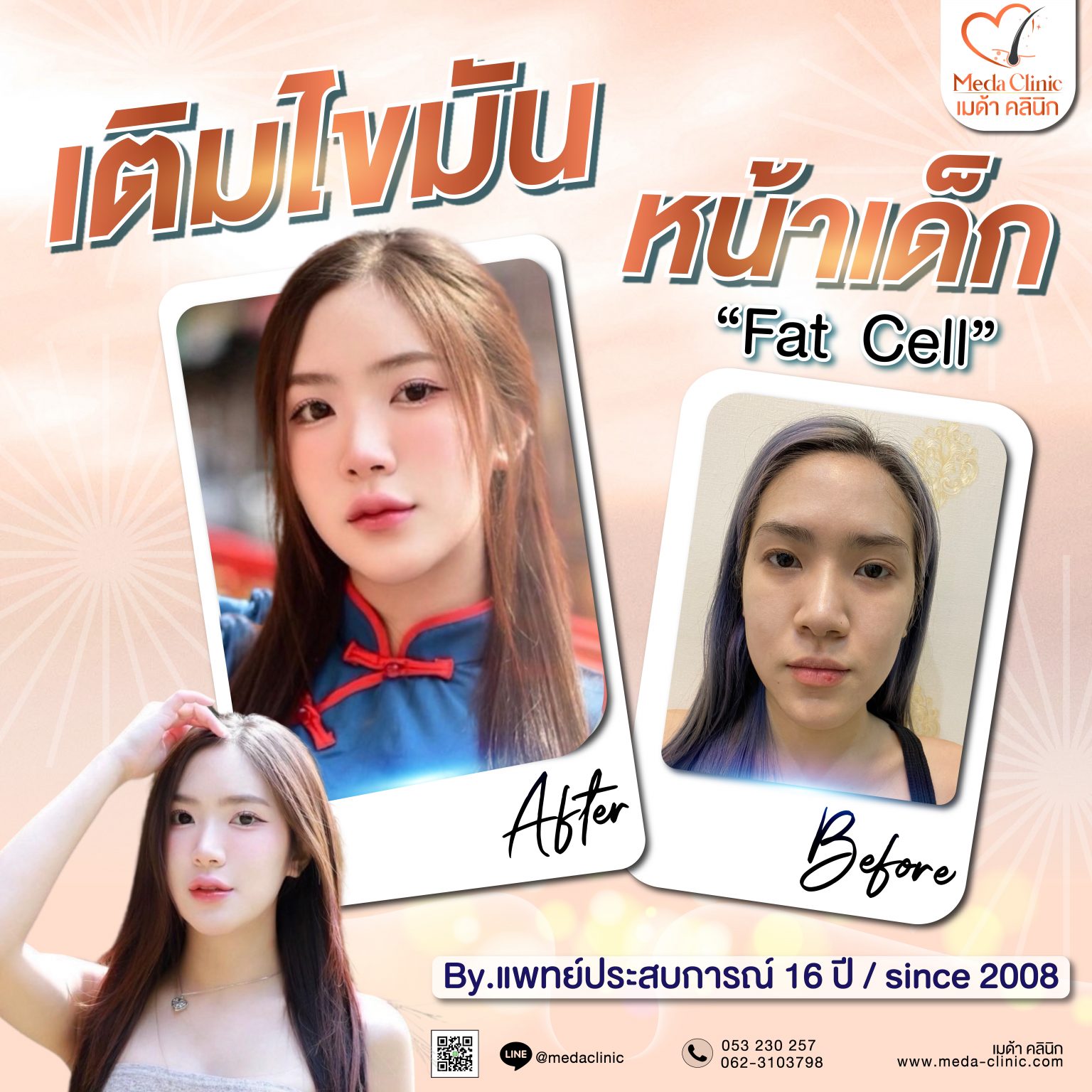 เติมไขมัน