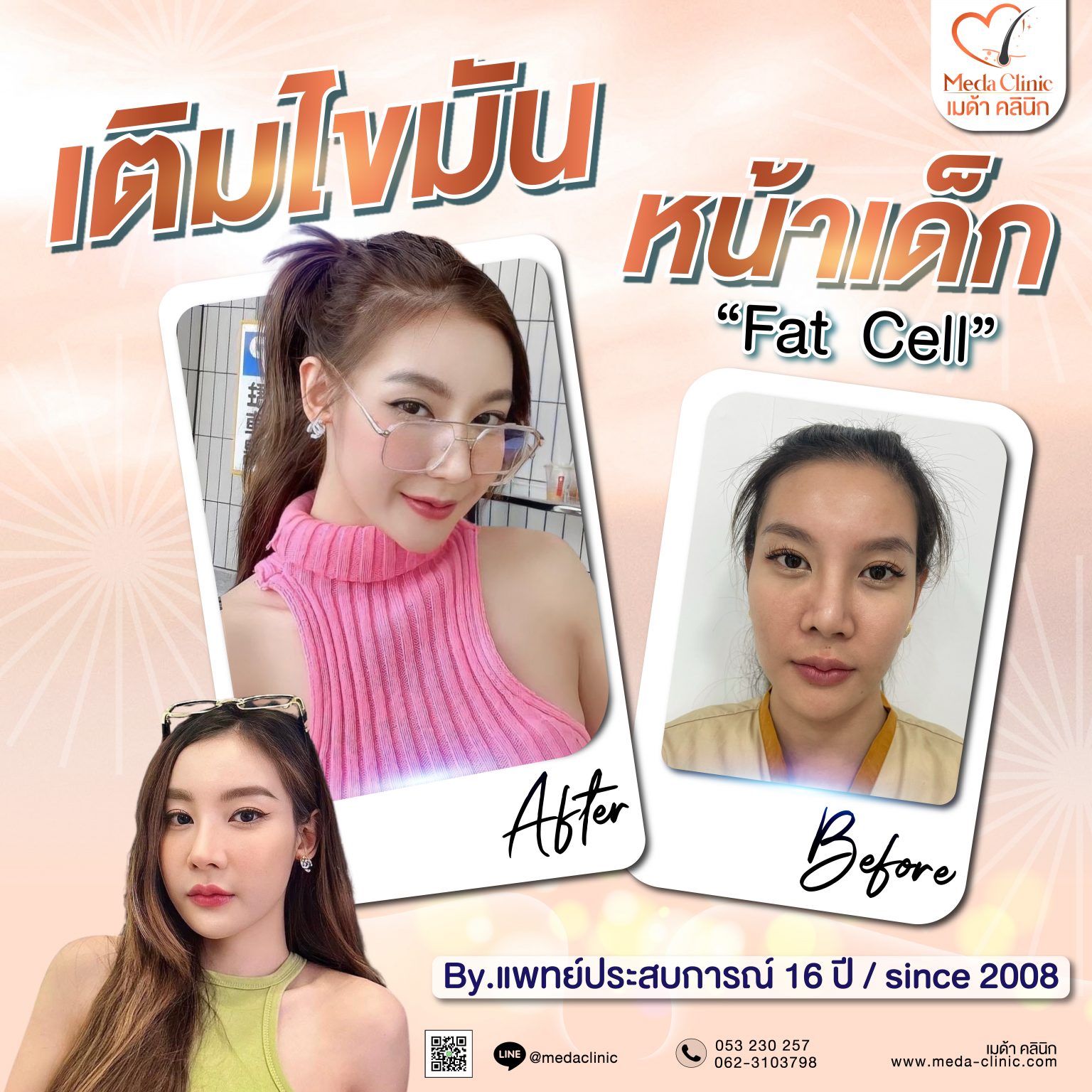 เติมไขมัน