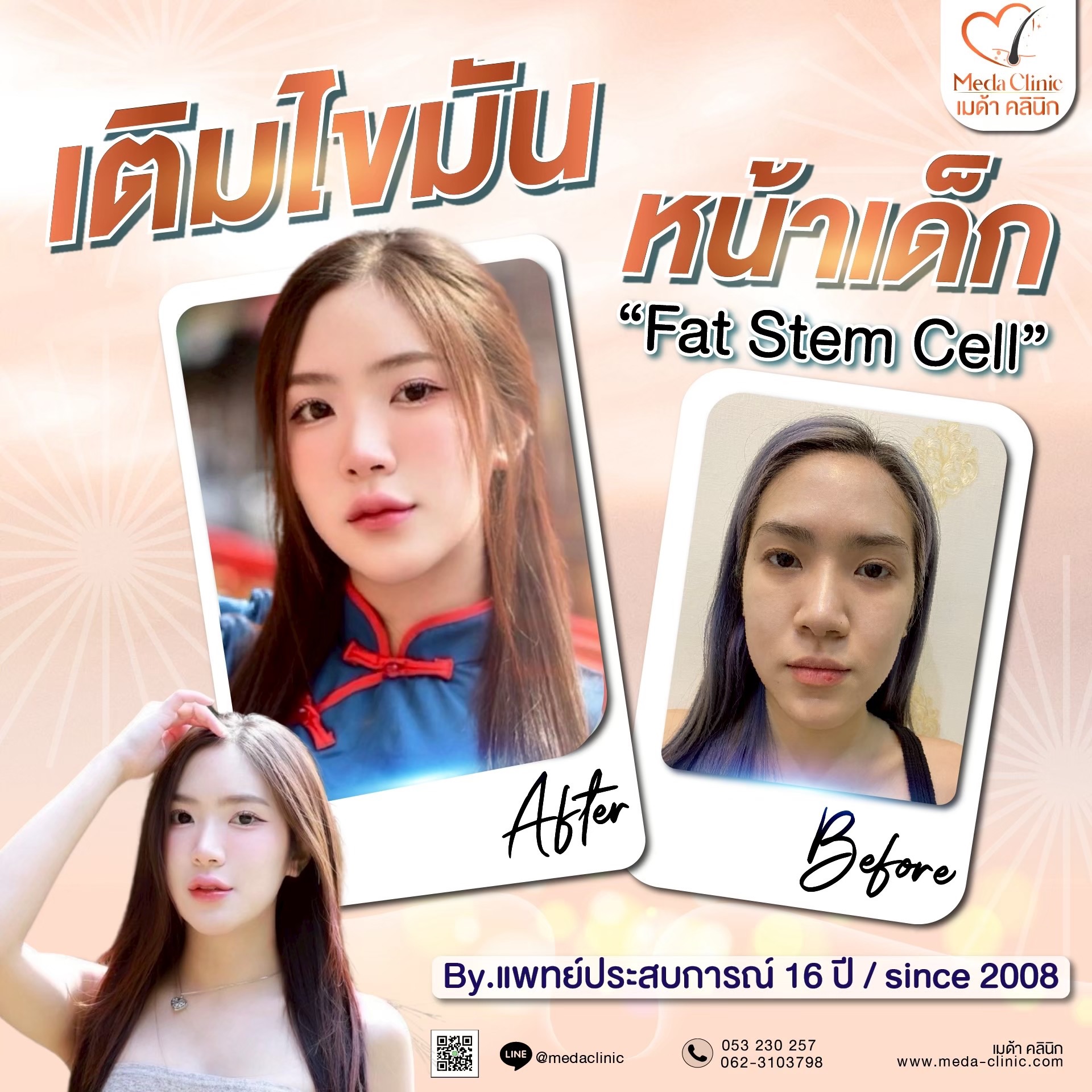 ฉีด fat หน้า เชียงใหม่