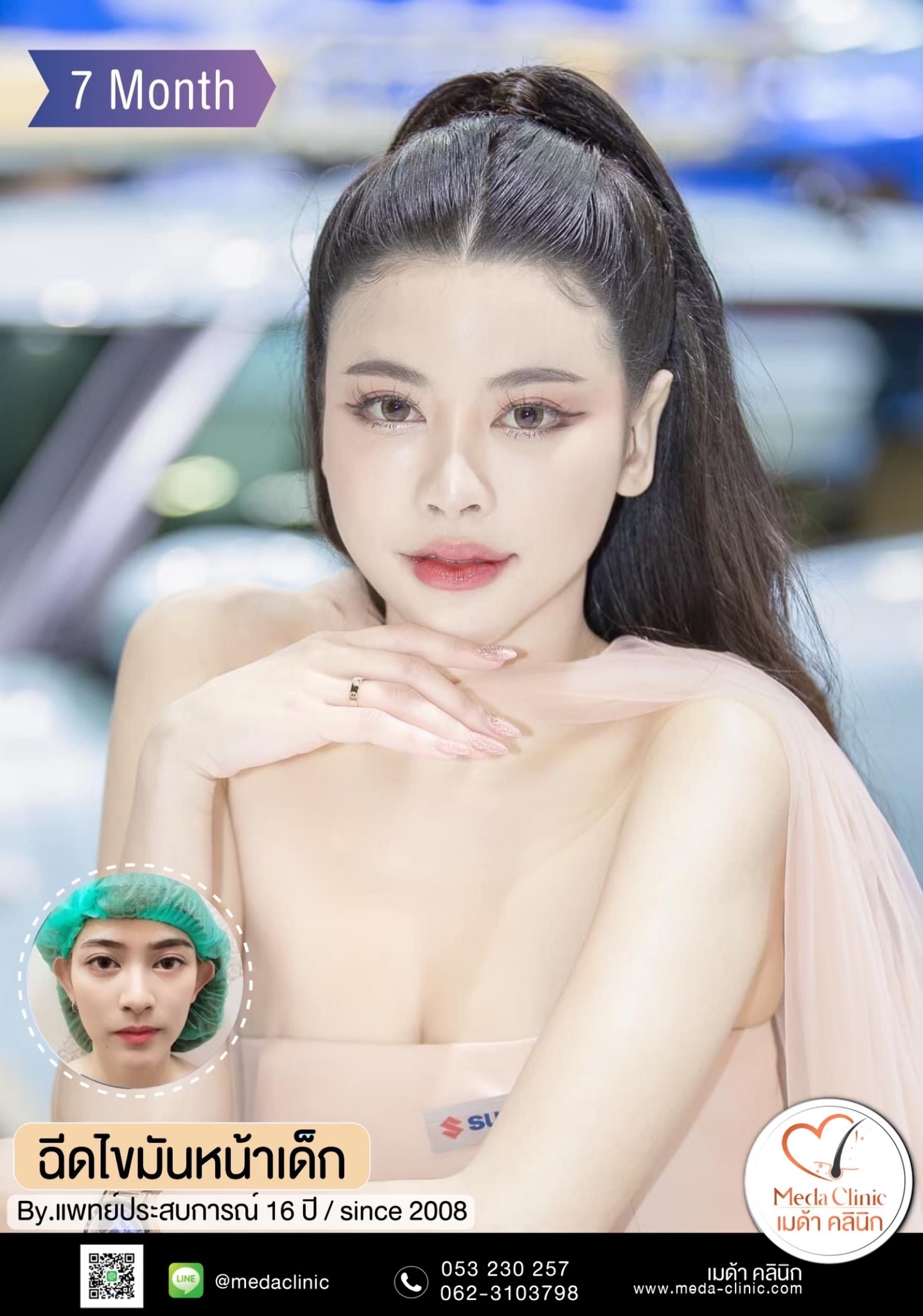 ฉีด fat หน้า เชียงใหม่