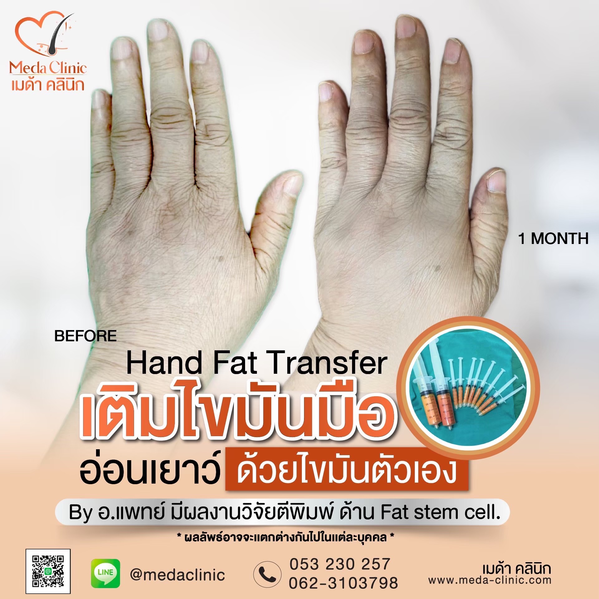 ฉีด fat หน้า เชียงใหม่