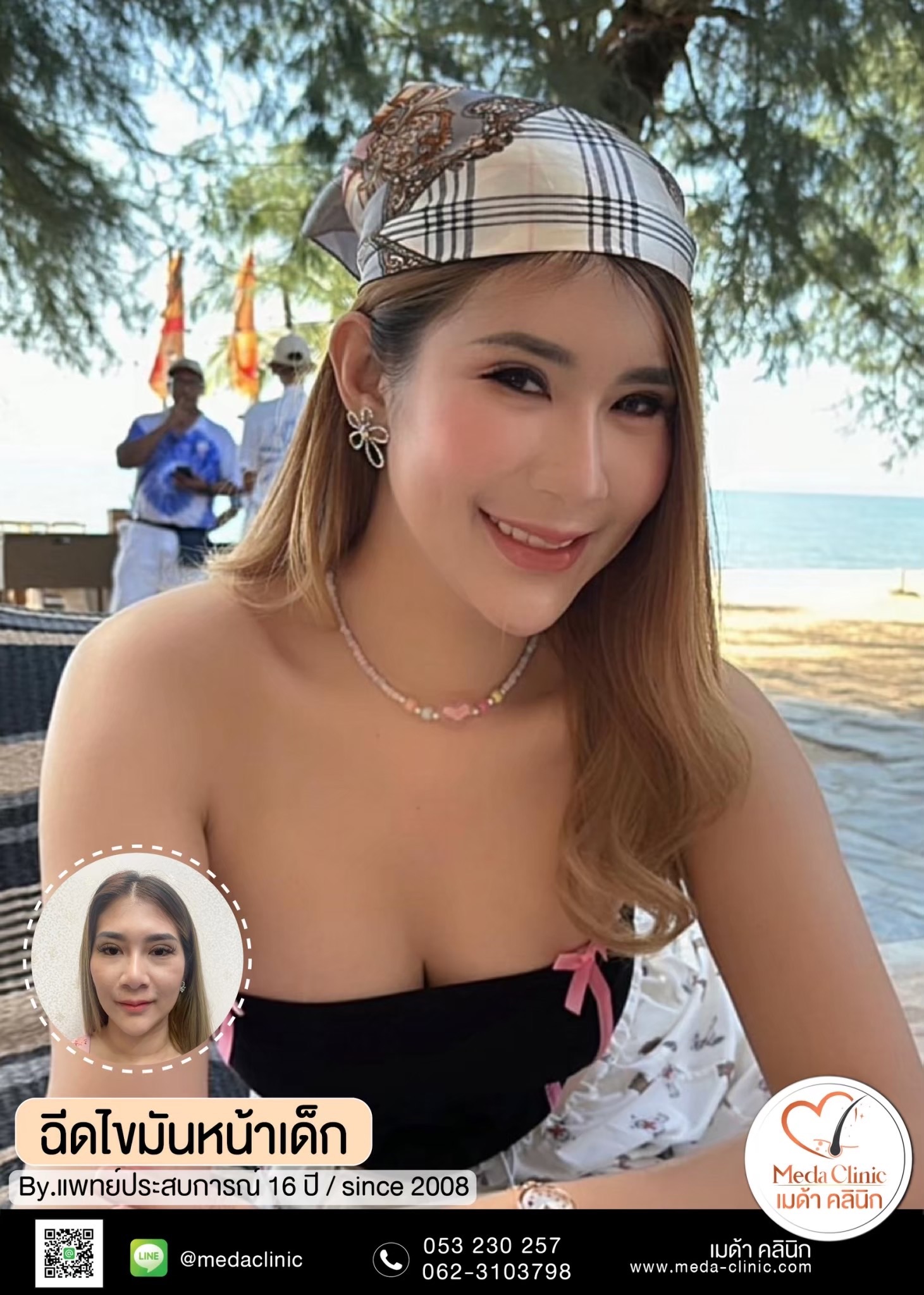 ฉีด fat หน้า เชียงใหม่ ฉีด fat หน้า เชียงใหม่