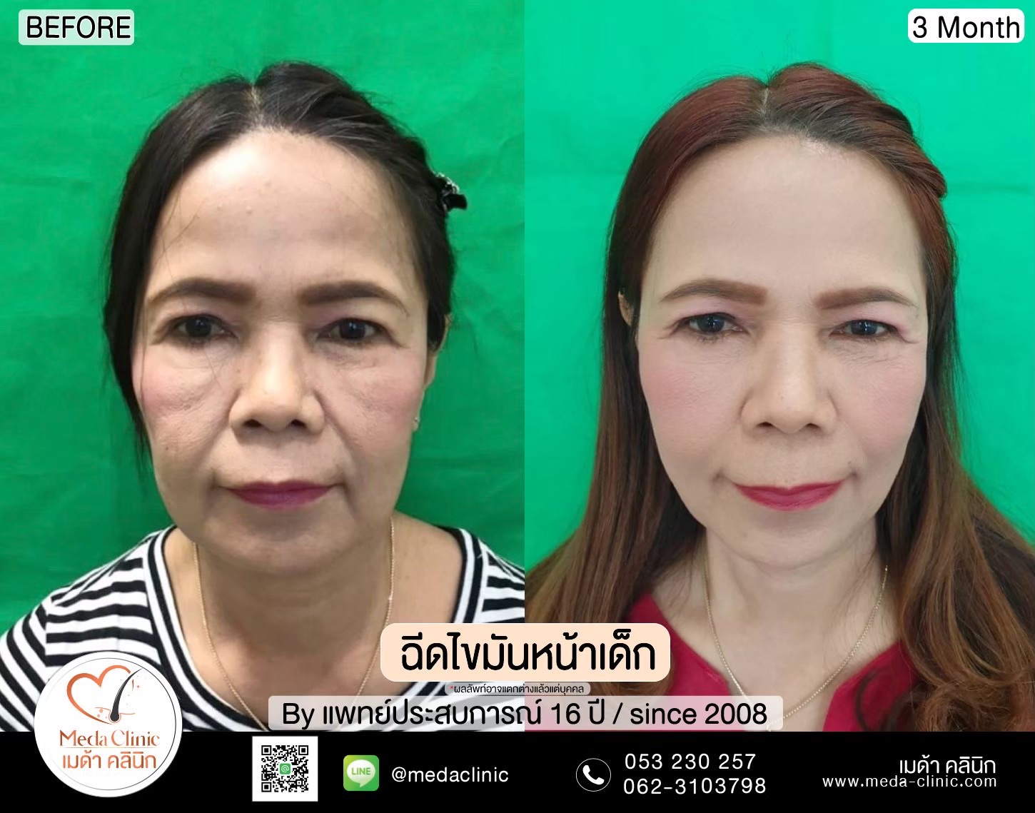 ฉีด fat หน้า เชียงใหม่