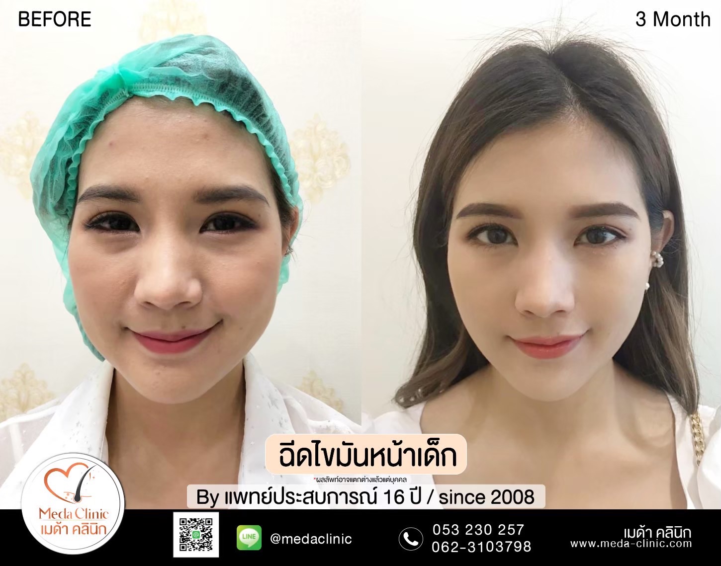 ฉีด fat หน้า เชียงใหม่