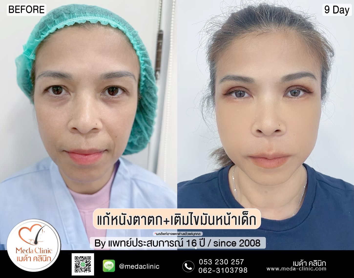 ฉีด fat หน้า เชียงใหม่