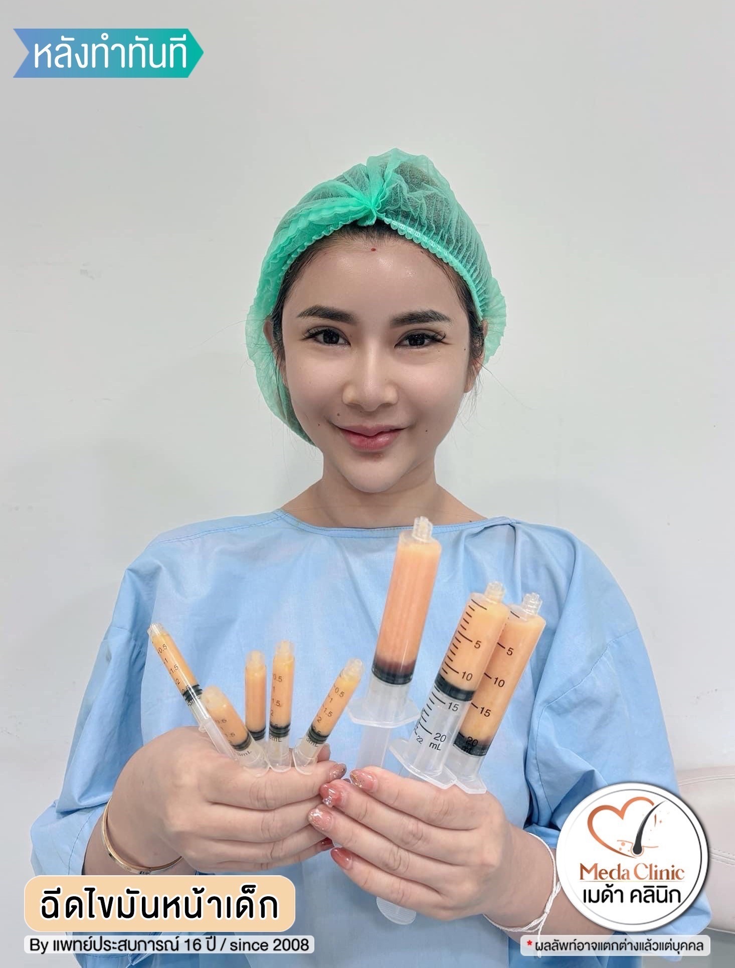 ฉีด fat หน้า เชียงใหม่