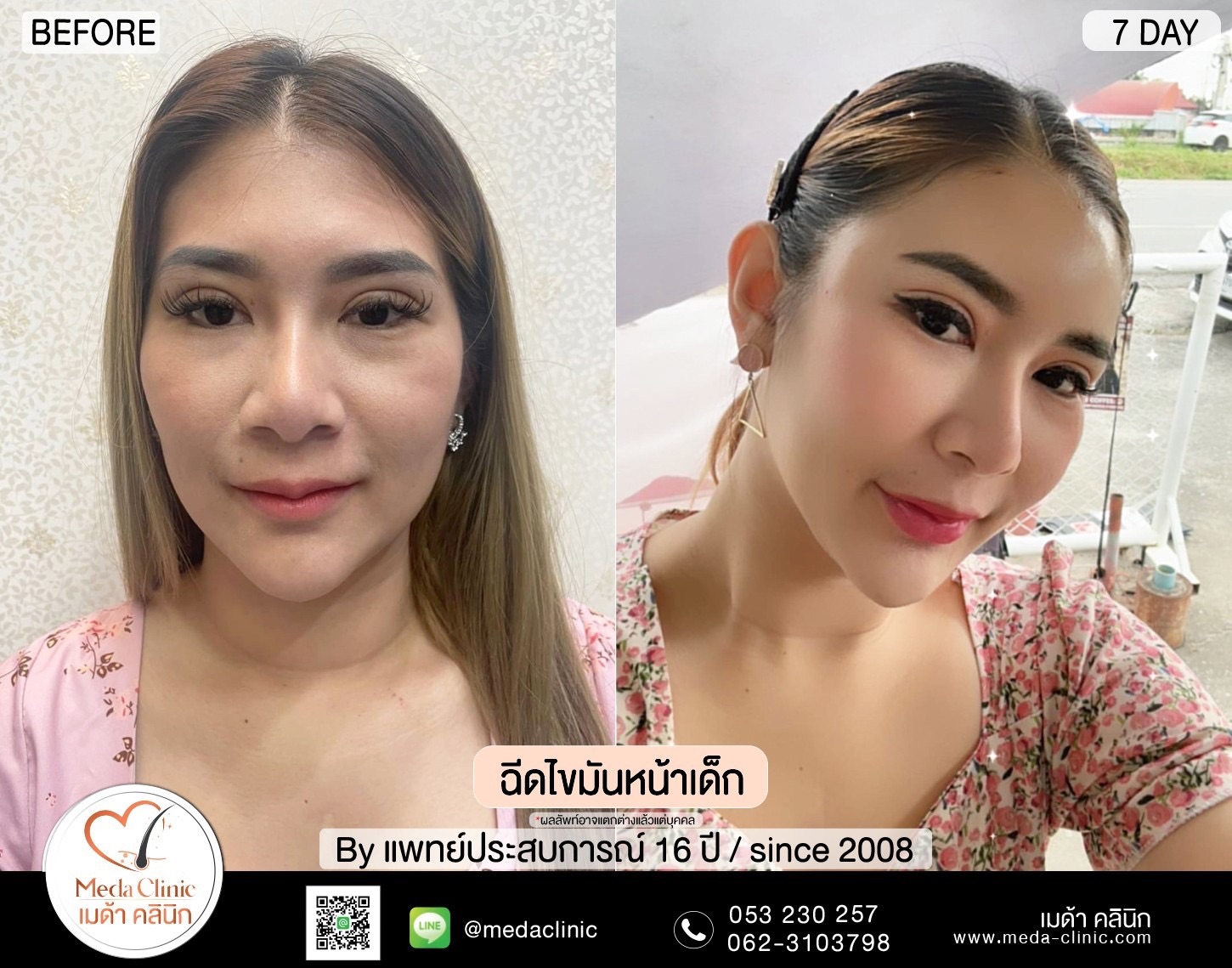 ฉีด fat หน้า เชียงใหม่