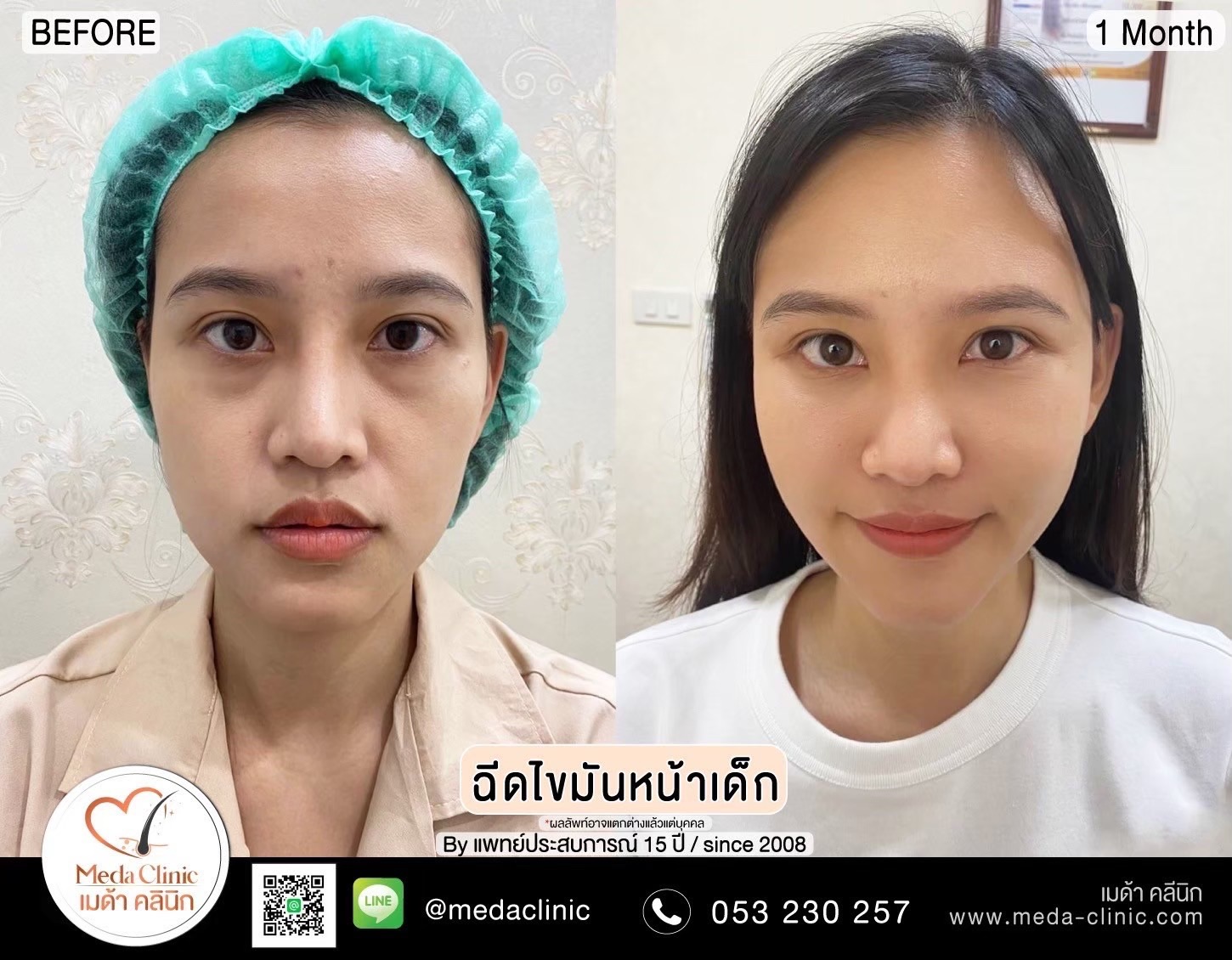 ฉีด fat หน้า เชียงใหม่