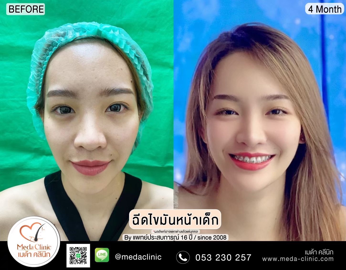 ฉีด fat หน้า เชียงใหม่