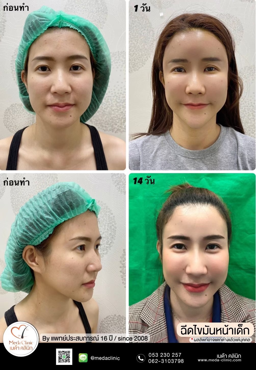 ฉีด fat หน้า เชียงใหม่