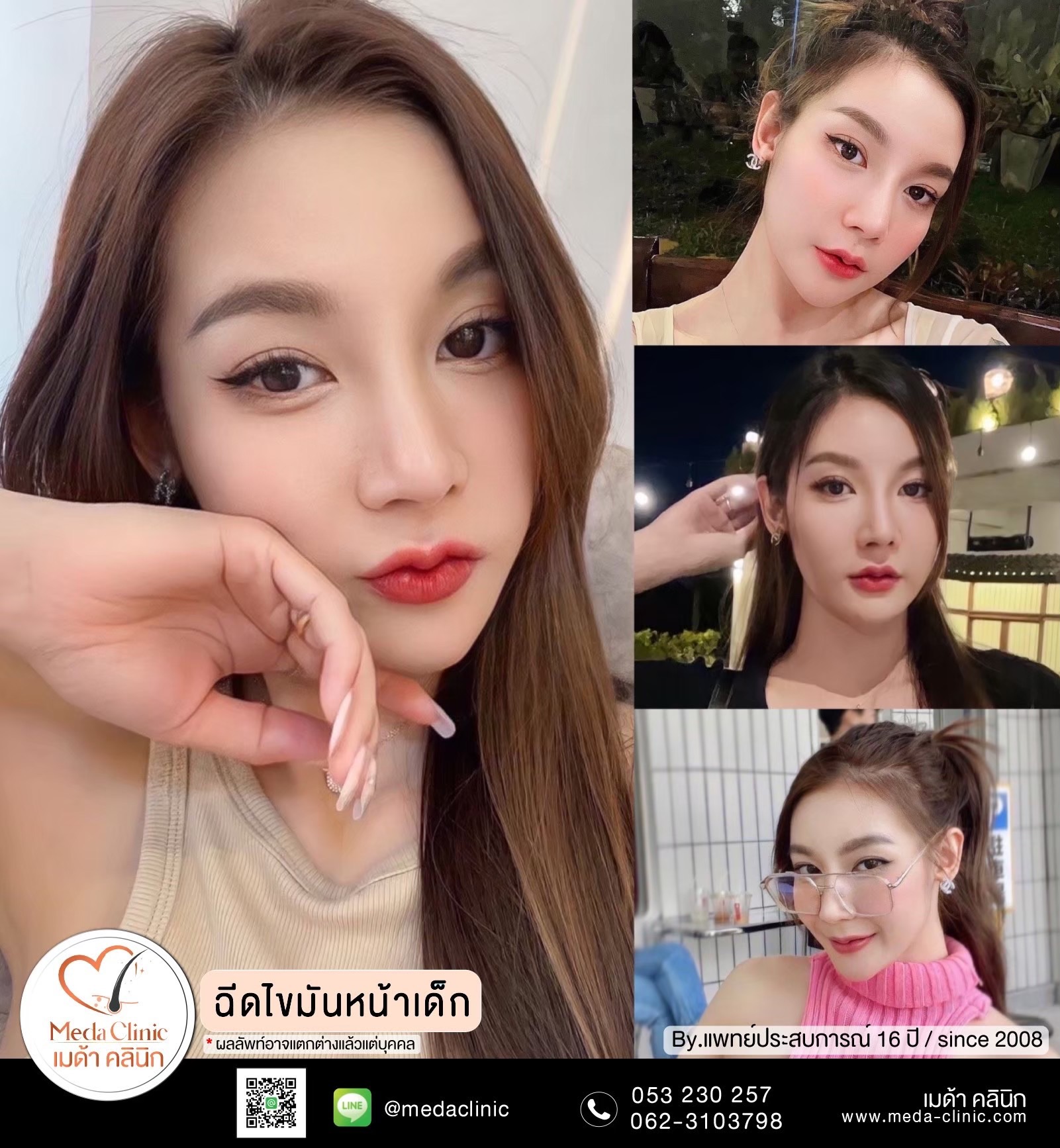 ฉีด fat หน้า เชียงใหม่