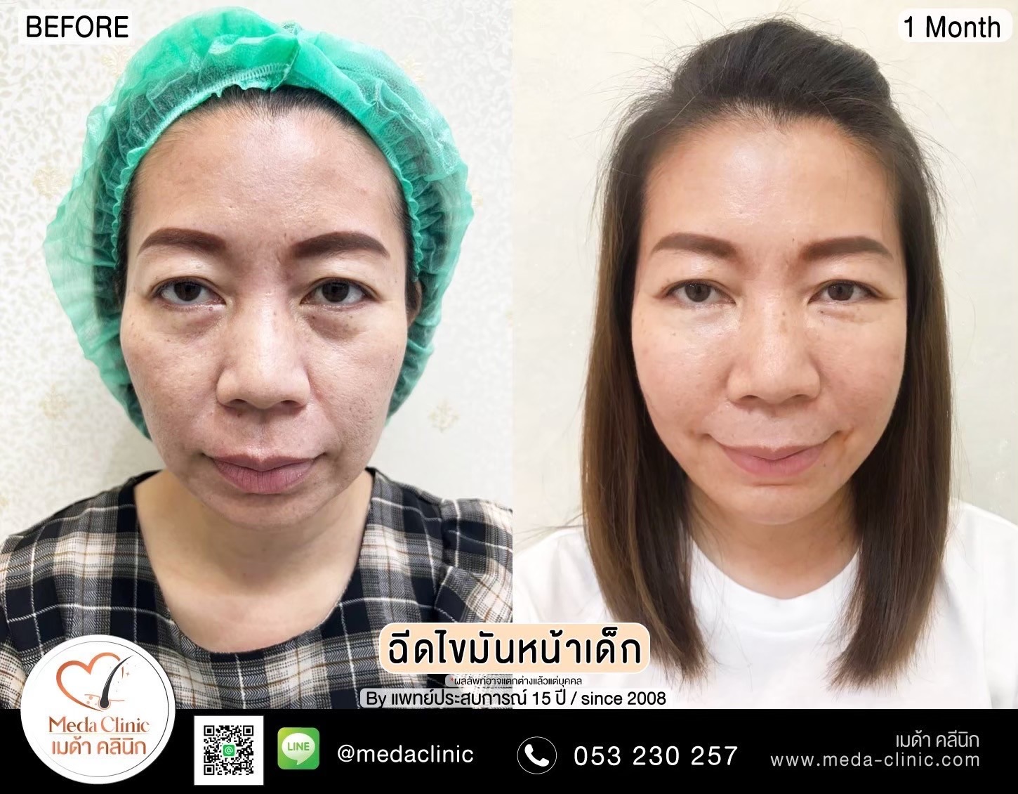 ฉีด fat หน้า เชียงใหม่