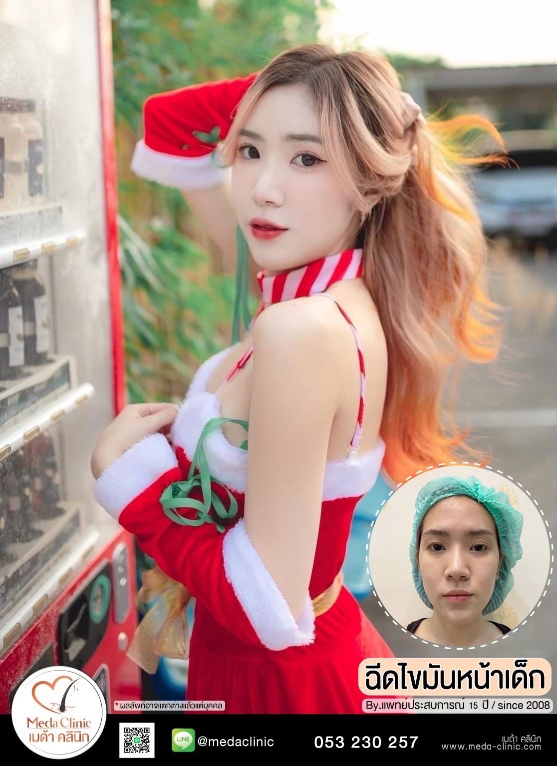 ฉีด fat หน้า เชียงใหม่