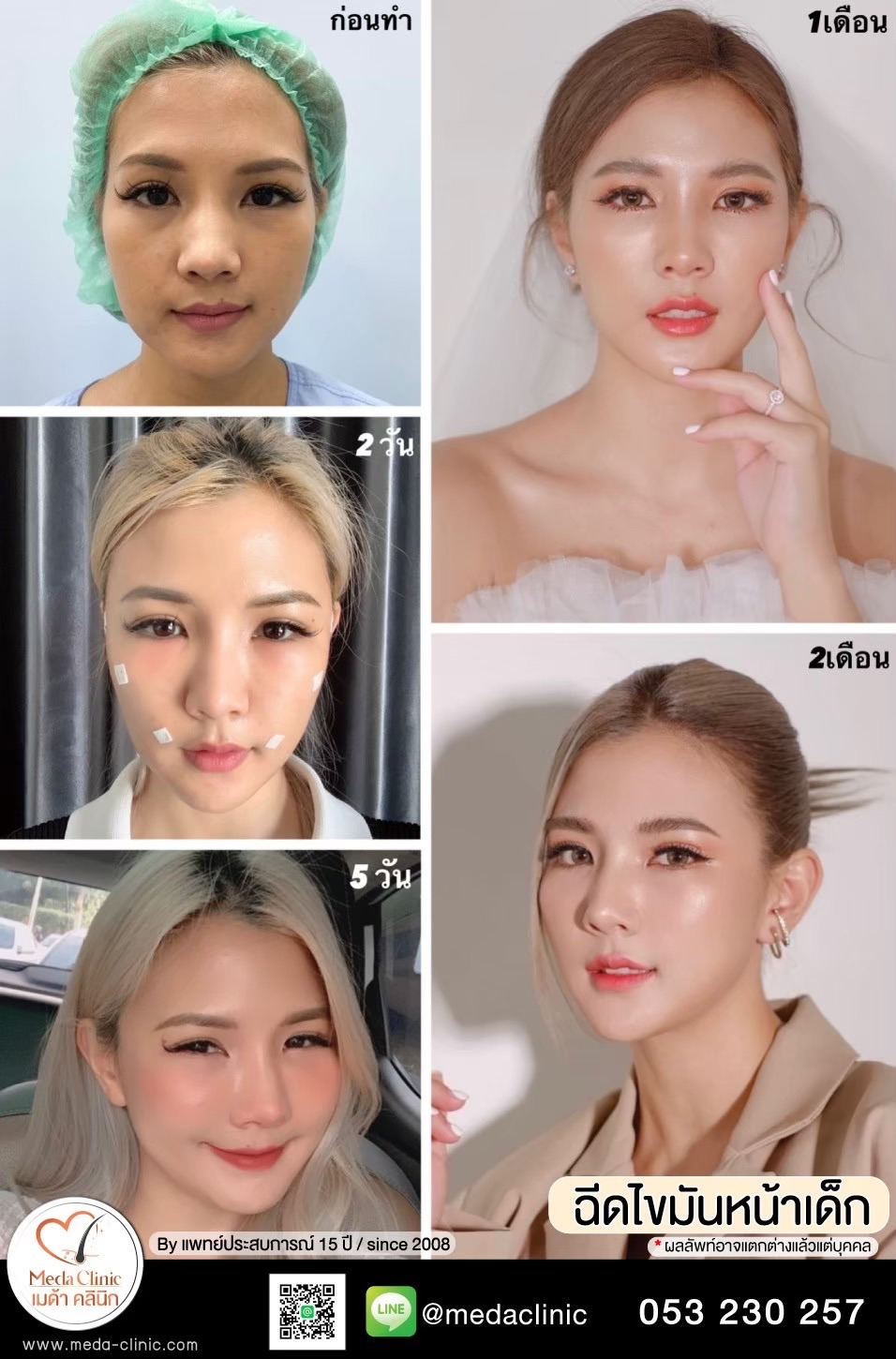 ฉีด fat หน้า เชียงใหม่